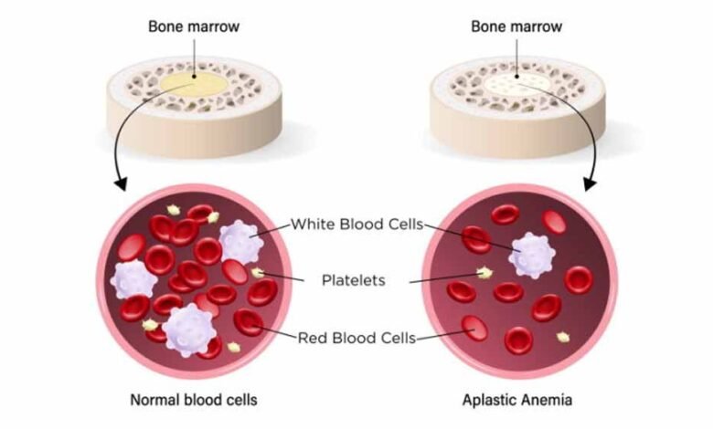 सिर्फ-एनीमिया-नहीं,-जानलेवा-भी-हो-सकता-है-एप्लास्टिक-एनीमिया-—-आम-खून-की-कमी-से-कितना-अलग-है-यह-रोग?