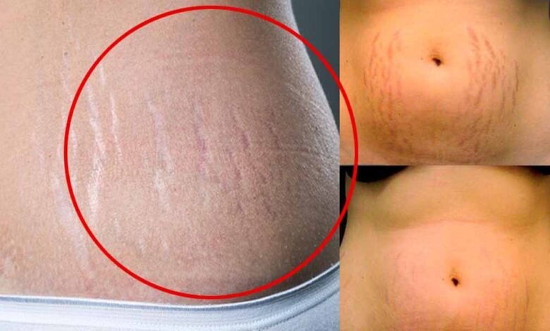 घर-बैठे-जिद्दी-स्ट्रेच-मार्क्स-हटाने-के-आसान-और-असरदार-तरीके