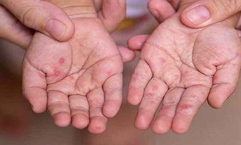 mp-में-खसरे-की-एंट्री:-4-जिलों-में-12-नए-मरीज,-स्वास्थ्य-विभाग-अलर्ट-मोड-पर;-घर-घर-सर्वे-शुरू