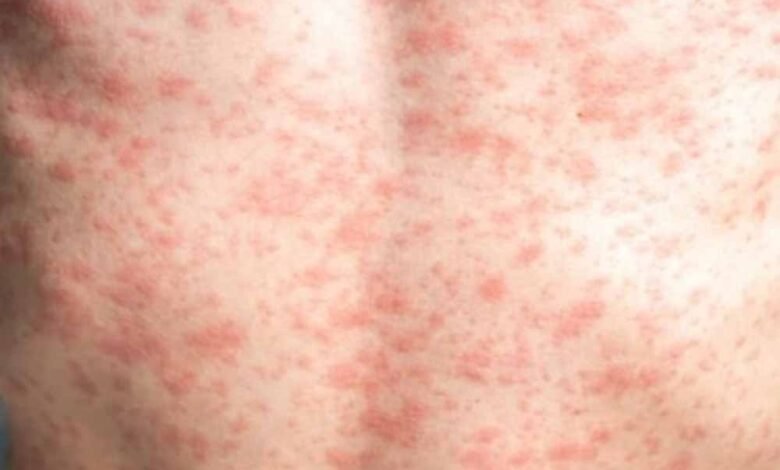 रतलाम-में-खसरे-का-प्रकोप:-10-बच्चों-में-संक्रमण,-स्वास्थ्य-विभाग-ने-किया-फ्लैग-मार्च