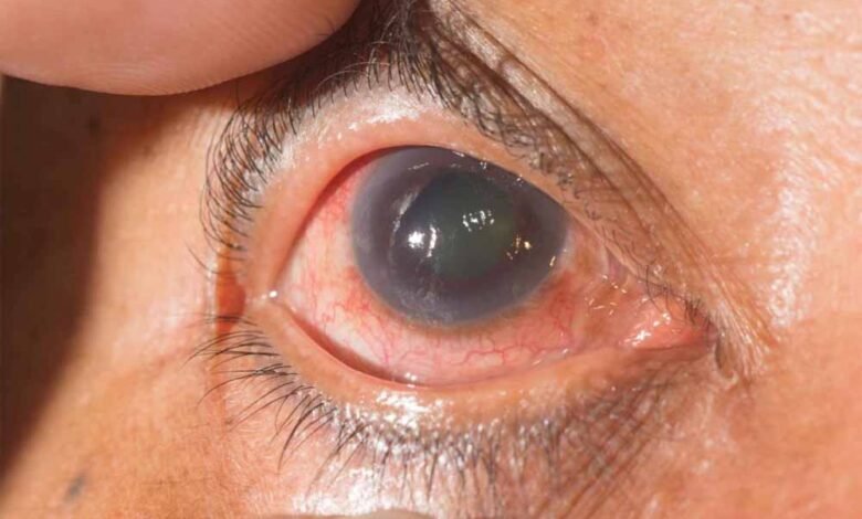 साइलेंट-चोर-‘ग्लूकोमा’-से-सावधान!-आंखों-में-दिखें-ये-संकेत-तो-तुरंत-कराएं-जांच