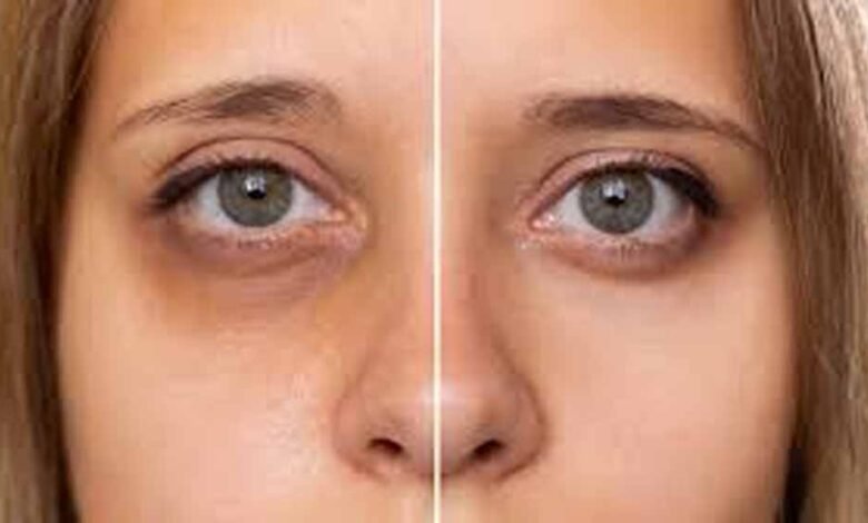 आंखों-के-काले-घेरे-से-छुटकारा-पाने-के-आसान-और-असरदार-उपाय