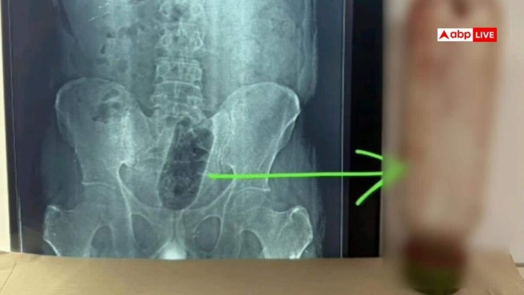 up-news:-आगरा-में-युवक-के-मलाशय-में-फंसी-1-लीटर-पानी-की-बोतल,-डॉक्टरों-ने-सर्जरी-कर-निकाली