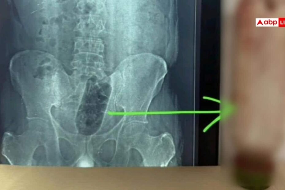 up-news:-आगरा-में-युवक-के-मलाशय-में-फंसी-1-लीटर-पानी-की-बोतल,-डॉक्टरों-ने-सर्जरी-कर-निकाली