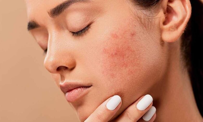 बार-बार-पिंपल्स-निकल-रहे-हैं?-ये-सिर्फ-गंदगी-नहीं,-अंदर-छिपी-इन-बीमारियों-का-हो-सकता-है-संकेत