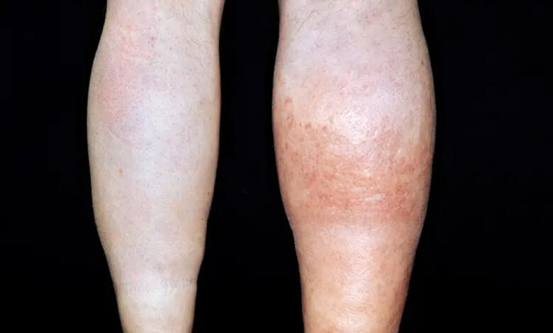 पैरों-में-सूजन-और-दर्द-को-न-करें-नजरअंदाज-रिसर्च-में-खुलासा-आपके-जीन-बढ़ा-सकते-हैं-खून-के-थक्के-जमने-का-खतरा