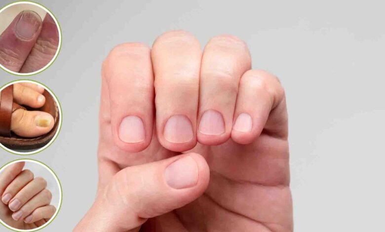 क्या-आपके-नाखून-भी-हो-रहे-हैं-पीले-या-नीले?-जानें-शरीर-में-छिपी-किन-बीमारियों-की-ओर-है-यह-इशारा