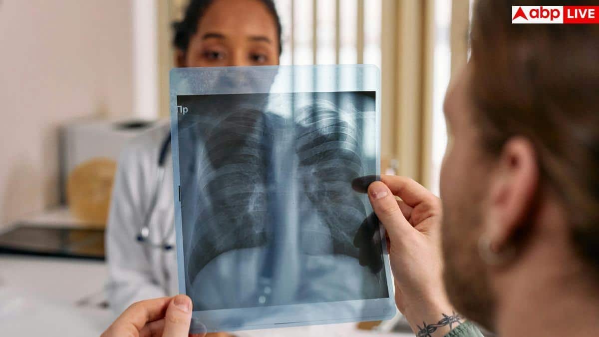 Delhi TB Screening: राजधानी में टीबी के खिलाफ बड़ी कार्रवाई, स्लम और हाई रिस्क इलाकों से सामने आए 12000 मरीज